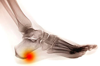Heel Spurs Treatment  Foot Doctor North York, ON and Mississauga, ON