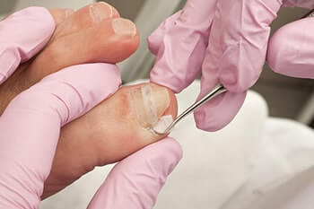 Ingrown Toenails  Advanced Foot & Orthotic Clinic