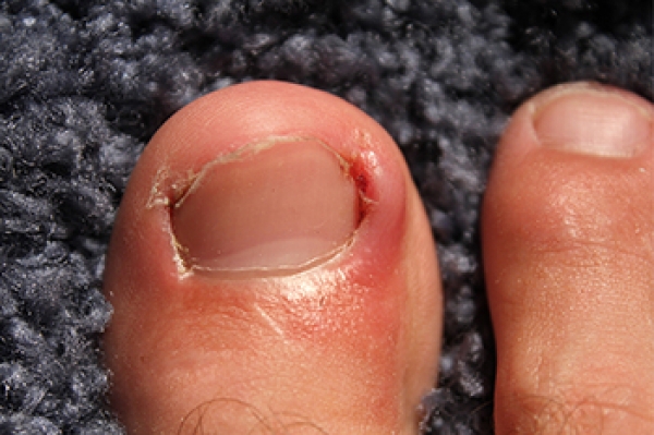 What causes an ingrown toenail - Symptoms and Signs